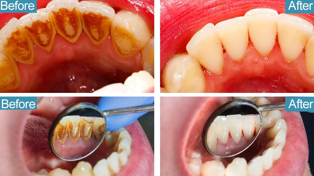 Ultrasonic Calculus Teeth Cleaner