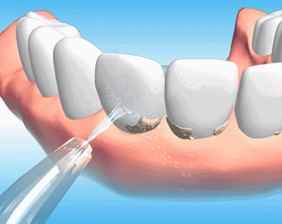 Waterpulse Oral Irrigator Dental Water Flosser