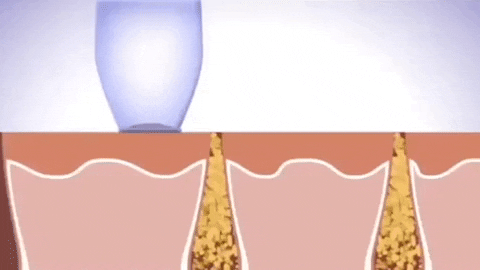 Electric Blackhead Pore Vacuum